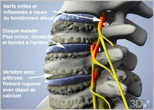 Pour mieux vivre avec l’arthrose et limiter son évolution